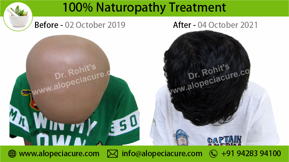 Alopecia Areata Result 1